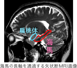海馬の長軸を通過する矢状断MRI画像