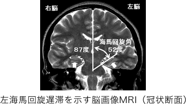 左海馬回旋遅滞を示す脳画像MRI（冠状断面）