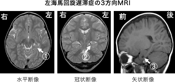 左海馬回旋遅滞症の3方向MRI