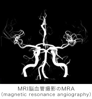MRI脳血管撮影のMRA（magnetic resonance angiography）