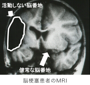 脳梗塞患者のMRI