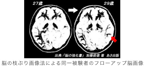 脳の枝ぶり画像法による同一被験者のフローアップ脳画像