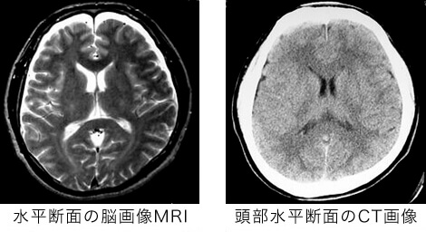 左・水平断面の脳画像MRI、右・頭部水平断面のCT画像